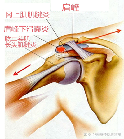 左肩膀疼痛部位图图片